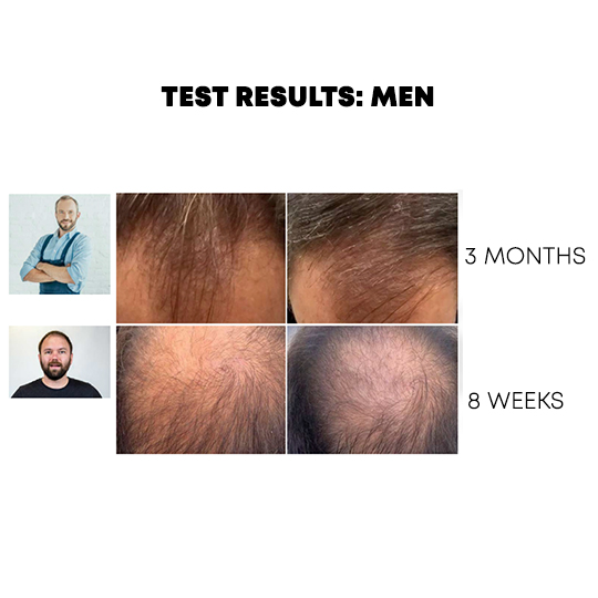 Natucain Hair Loss Treatment 100ml